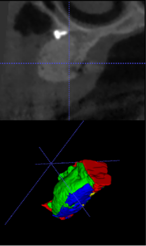 Figure 6: ** Volumetric measurements per implant site. **A:** implant placed at the gutta percha markers in a prosthetically driven position. **B:** Pivots indicating the two vertical and the apical cut, 1.5 mm from the implant surface. **C:** PreopV at the ROI of the implant site (white arrow). **D:** FinalV (black arrow) measured at implant level. **E:** PostopV at implant site [28].