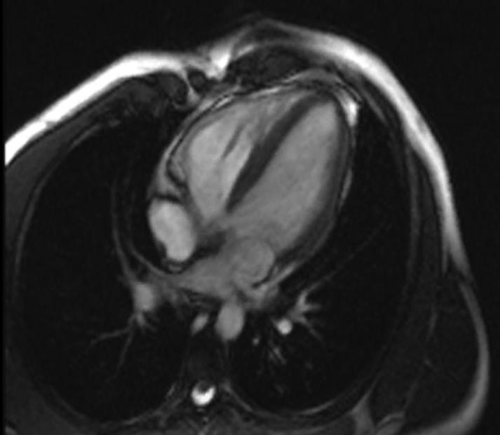 Figure 1: Cardiac magnetic resonance: SSFP cine acquisition in the four-chamber view. The image shows a right ventricle with normal volume.