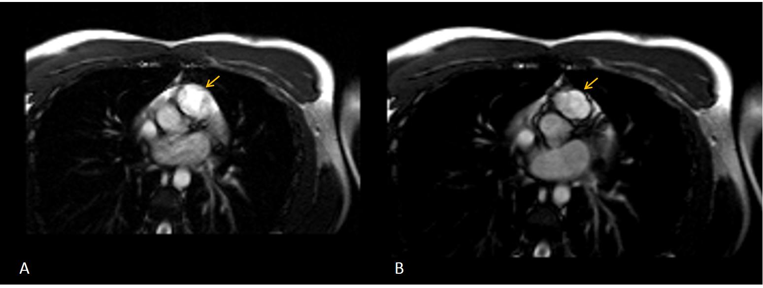 Figure 2: Cardiac magnetic resonance: SSFP cine acquisition in plane with pulmonary valve during sistole A: diastole B: The image shows a quadricuspid pulmonary valve causing an incomplete diastolic closure (arrows).