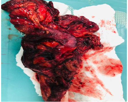 Figure 1: Hostile abdomen.