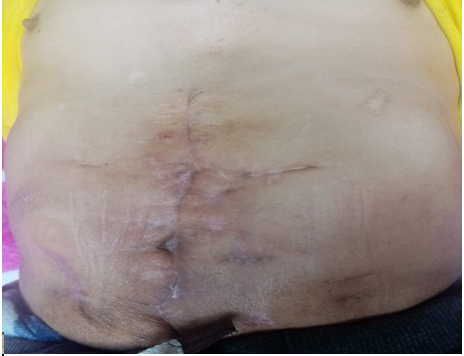 Figure 3: Intestinal resection.