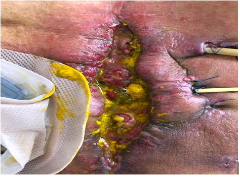 Figure 4: ** Post-surgical wound.