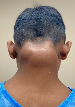 Figure 1: Lobulated mass of approximately 5 × 4 × 4 cm in the cervical region.
