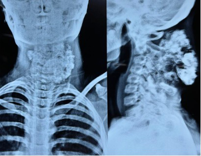 Figure 2: X-ray lateral and anteroposterior show lobulated mass and no obvious airway compromise.