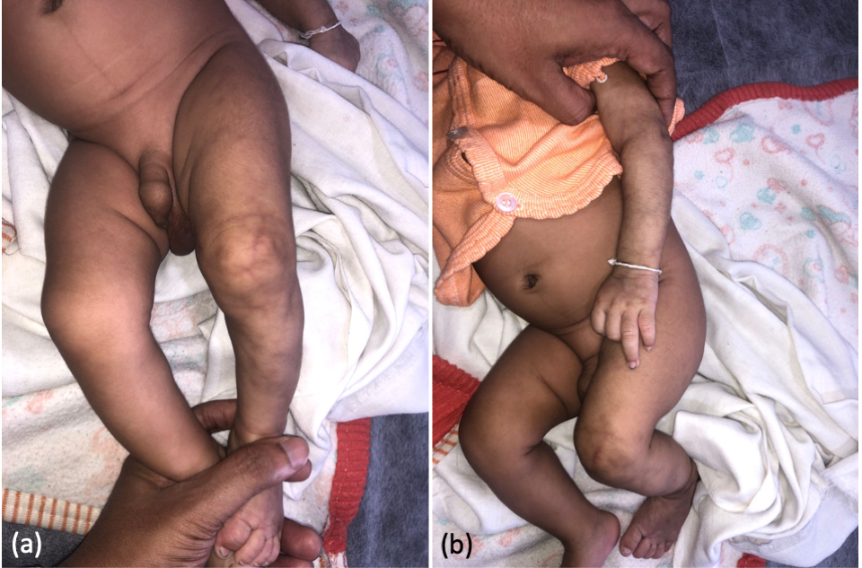 Figure 1: Reticulate erythema over the left (a) lower and (b) upper limbs. The lower limb appears leaner than the contralateral limb.