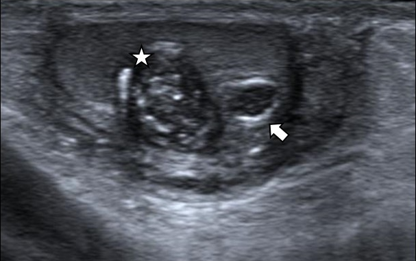 Figure 1: Ultrasound showing micro calcifications (star) and hyper echoic rim (arrow).