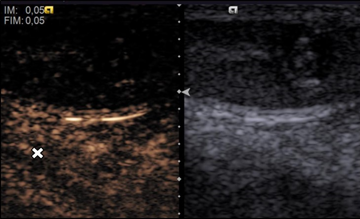 Figure 2: Contrast enhanced ultrasound. No contrast enhancement (cross) identified in either of two lesions.