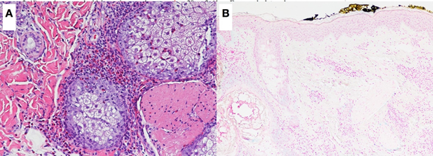 Figure 2: (A) Prominent perifollicular infiltrate with eosinophils. Hematoxylineosin x 20. (B) Colloidal iron 10x shows mild intrafollicular mucinosis.
