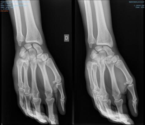 Figure 1: X-ray of the hand and wrist in profile; Frontal and oblique showing a carpo-metacarpal dislocation of the fourth and fifth fingers.