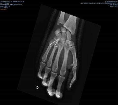 Figure 2: Postoperative control radiograph of the hand and wrist oblique and face incidence showing the reduction of the fourth and fifth finger carpal-metacarpal dislocation and stabilisation by two oblique pins.