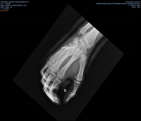 Figure 3: X-ray of the hand face after removal of the two pins showing the integrity of the articular surfaces of the 4th and 5th radius.