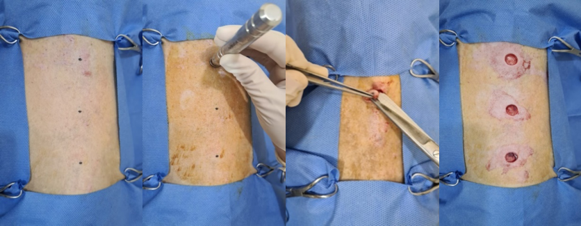 Figure 1: From left to right: Demarcation; punch use; excision of the skin fragment; circular incisions.