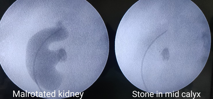 Figure 1: Malrotated kidney.