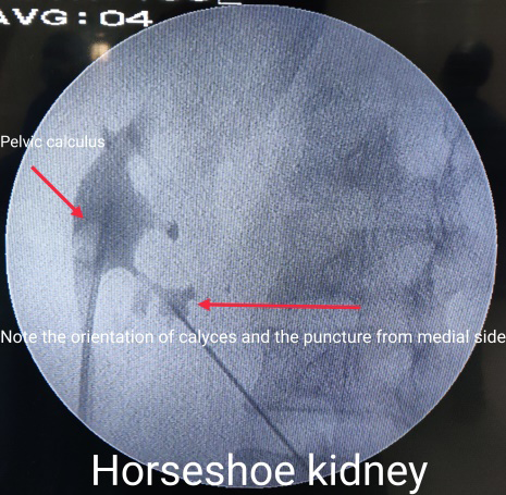 Figure 2: Horseshoe Kidney.