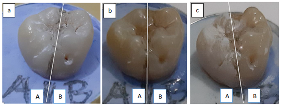 Figure 1: A: Extracted Tooth, divided into 2 Equal Parts; B: (A): The Uncoated Part and (B): the Coated Part (B); C: After Soaked in Acid Solution.