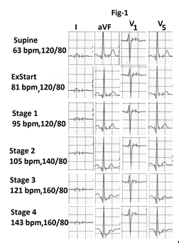 Figure 1: Part of the average page of treadmill stress test report from a person with type 1 response. Heart rate shows progressive, nearly linear increase in heart rate. There is no evidence of exercise induced schemia in leads I, aVF, V1 and V5.