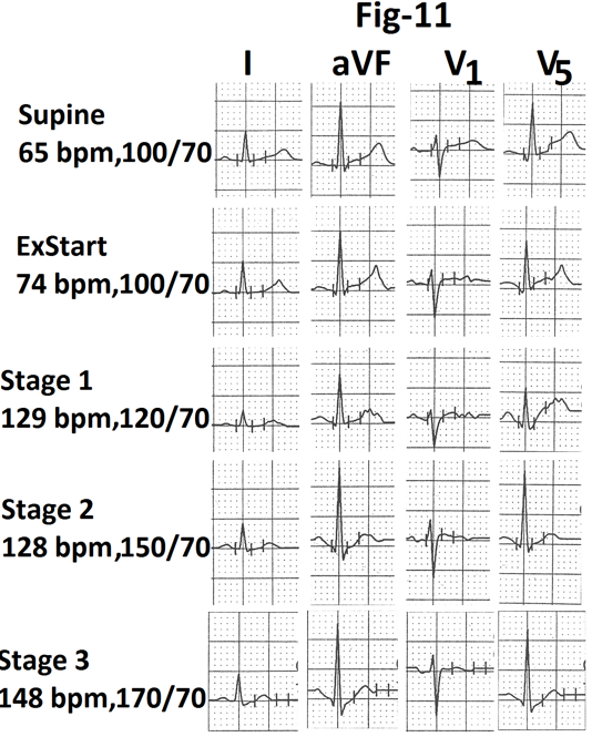 Figure 11: Part of the average page of treadmill stress test report from a person with type 3b response showing absence of any increase in heart rate during stage 2.
