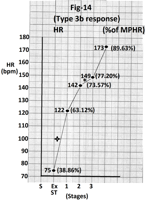 Figure 14: Graph of heart rate at the end of different stages of exercise of the person whose treadmill stress test report is shown in Figure 13. There is minimal increase (7beats/minute) during stage 2 (marked). There is significant increase in heart rate (47 beats/minute) from supine position to start of exercise (marked). Abbreviations - HR- heart rate, bpm- beats per minute, S- Supine, Ex ST - Exercise start, ST - Stage of stress, MPHR- percentage of age predicted maximal heart rate.