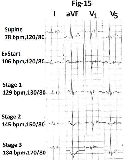Figure 15: Representative tracings of leads I, aVF, V1 and V5 are also shown in Figure 15. There is no evidence of exercise induced ischemia. Graph showing heart rate and percentage of MPHR attained at the end of different stages of stress from the same person are shown in Figure 16. There is significant increase in heart rate (39 bpm) during stage 3(marked).