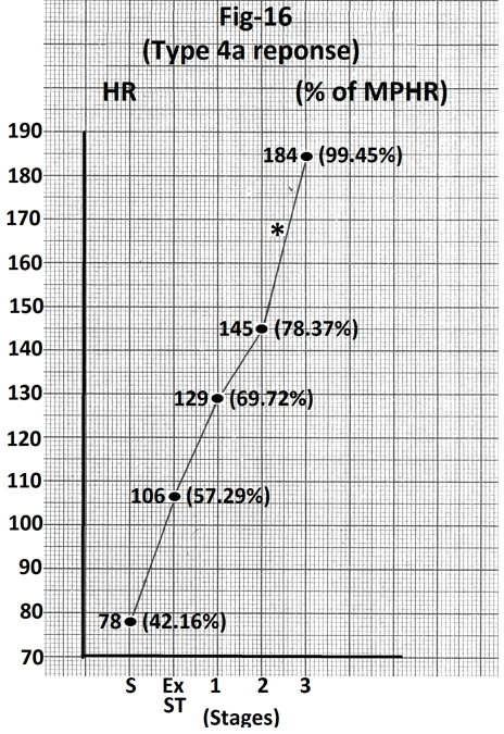 Figure 16: Graph of heart rate at the end of different stage of exercise of the person whose treadmill stress test report is shown in figure 15. There is significant increase in heart rate (39 beats per minute) during stage 3 (marked). Abbreviations- HR- heart rate, bpm- beats per minute, S- Supine, Ex ST - Exercise start, ST - Stage of stress, MPHR- percentage of age predicted maximal heart rate.