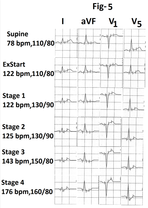 Figure 5: Representative tracings of leads I, aVF, V1 and V5 are also shown in Figure 5. There is no evidence of exercise induced myocardial ischemia. Graph showing heart rate and percentage of MPHR attained at the end of different stages of stress from the same person is shown in Figure 6. There is no increase in heart rate during stage 1(marked). Was significant increase in heart rate (44bpm) from supine position (s) to starting of exercise (Ex start)? There was during stage 1.