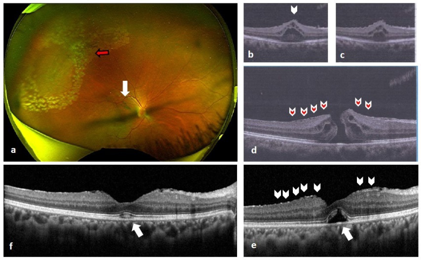 Figure 1: a) Wide field colour fundus photo of right eye showing lasered lattice degeneration in superior temporal quadrant (red arrow) with presence of Weiss ring (white arrow). b,c) OCT showing retinal elevation of posterior vitreous attachment. d) OCT showing FTMH with continuous ILM (red arrow heads). e) SD-OCT on day of surgery showing closure of FTMH with multiple micro-breaks in ILM (white arrow-heads) and presence of outer retinal defect (white arrow). f) SD-OCT showing FTMH closure with complete resolution of ORD and regeneration of outer retinal photoreceptor in fovea (white arrow).