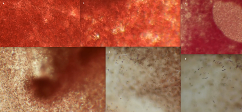 Figure 1: Microscopic examination of erythrocytes, erythrocytes plus normal saline, and erythrocytes plus Pfizer BioNTech. 100x microscopic analysis of subject 1 included analysis of (A) erythrocytes without added saline or Pfizer vaccine, and (B) erythrocytes with addition of normal saline solution to determine if changes in coloration of the erythrocytes were a dilutional effect. Further microscopic analysis following addition of Pfizer BioNTech with changes in erythrocytes seen at 30-seconds (C), and 1-2 minutes (D, E, F). Erythrocyte coalescence is seen in (E) and (F). Sequential imaging of erythrocytes exposed to normal saline did not reveal coalescence or reduction in red color (B) during this same time period. Images were taken from the recorded video of the investigation.