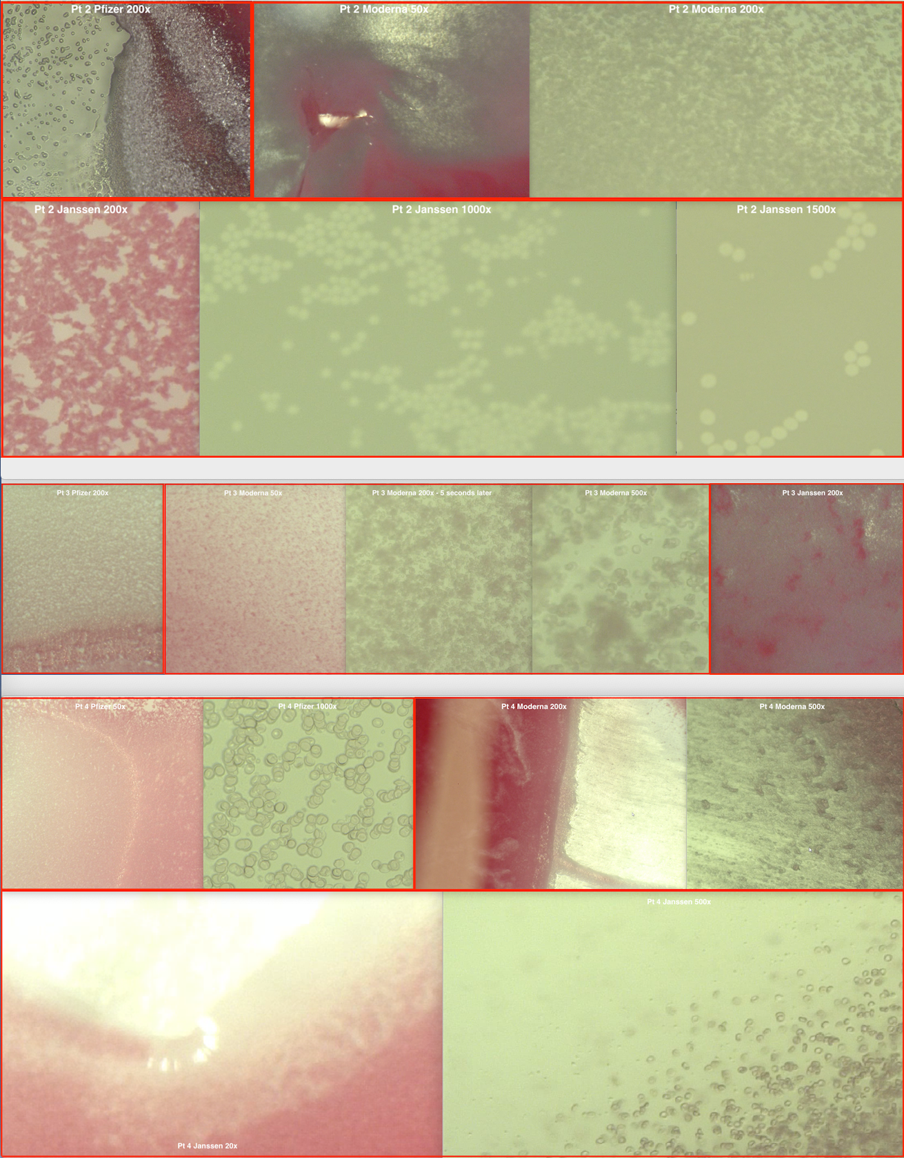 Figure 2: Microscopic examination of erythrocytes in six individuals before and after the addition of Pfizer BioNTech, Moderna and Janssen Ad26.COV2.S vaccines for SARS-CoV-2 (COVID-19). Patients 2 through 7 are each labeled along with the vaccine added and the microscopic power used for each image. Images were taken from the recorded video segments conducted at the time of the investigation. The results of each individual are shown for all three vaccines under powers ranging from 50x to 1500x.