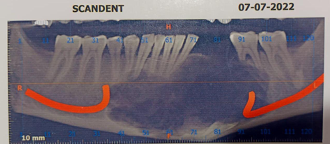 Figure 4: Cut section showing grey white, solid and homogenous tumour.