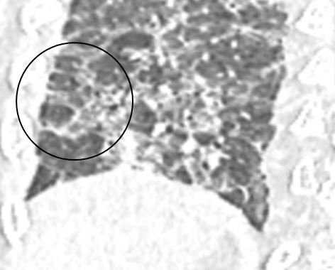 Figure 11: Perilobular fibrosis with ground glass haze, seen in the right lower lobe.