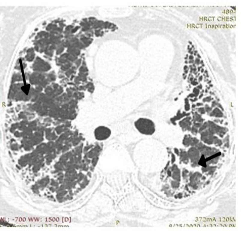 Figure 12: Axial HRCT scan showing spoke -wheel like peribronchial and subpleural fibrosis (arrows).