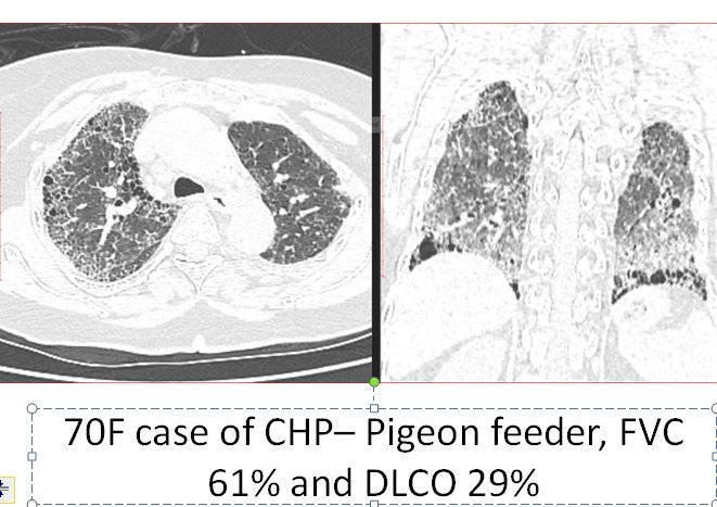 Figure 13: A 70 year old pigeon feeder with CHP (FVC 61% and DLCO 29%) showing diffuse fibrosis with honeycomb cysts and ground glass haze, affecting upper and lower lobes.