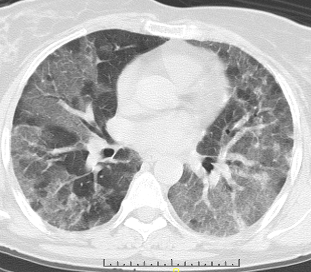Figure 15: Note the clear well demarcated area in the RUL (arrow) with minimal vascular marking- a “simplified area”.