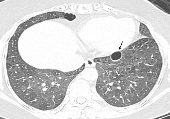 Figure 17: There is basilar ground glass haze with mild bronchial dilatation.