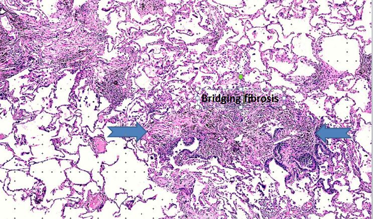 Figure 3: High power H & E stained image showing bridging fibrosis (arrows).