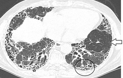 Figure 6: Expiratory scan (concave shape of tracheal ligament) shows air trapping in the upper lobes in (arrow). A mosaic pattern due to air trapping, in the upper lobes, is highly suggestive of HP.
