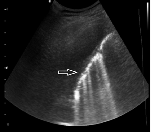 Figure 7: Simplified area in the left lower lobe (arrow). The circled area shows honeycombing. The asterisk shows traction bronchiolectasis. Note the lower lobe involvement in this patient.