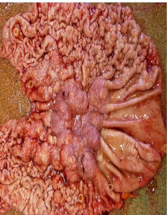 Figure 4: The macroscopic specimen revealed a diffusely edematous and polypoid gastric mucosa with sparing of the greater curvature of the stomach. A focal ulcerated area surrounded by large polypoid lesions, noted at the mid body of the stomach.