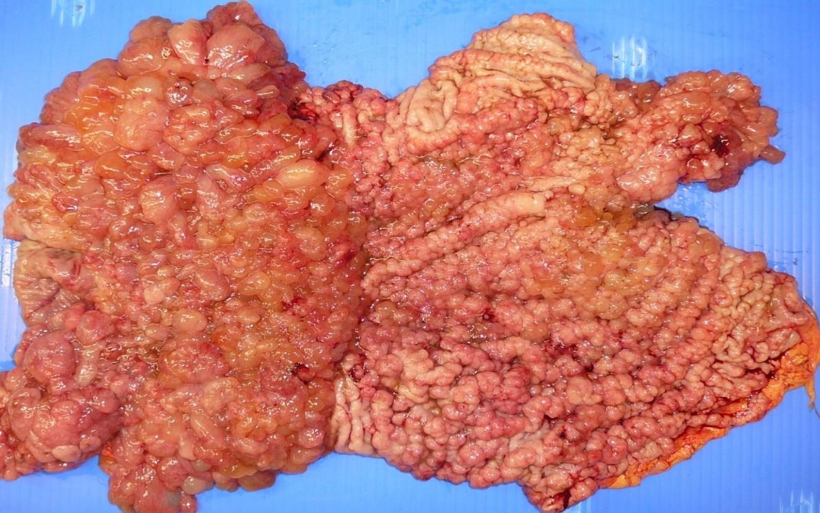 Figure 5: Diffuse polypoid lesions seen throughout the stomach