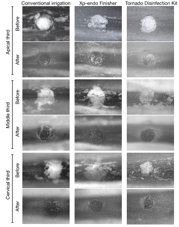 Figure 2: Representative stereomicroscope photos by third of the groups before and after irrigation.