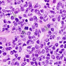 Figure 1: Adult T cell leukaemia/lymphoma demonstrating neoplastic lymphocytes with scant cytoplasm, condensed nuclear chromatin and inconspicuous nucleoli.