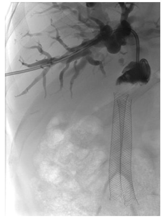 Figure 1: The CT scan shows the IPMN bulging into the wide CBD.