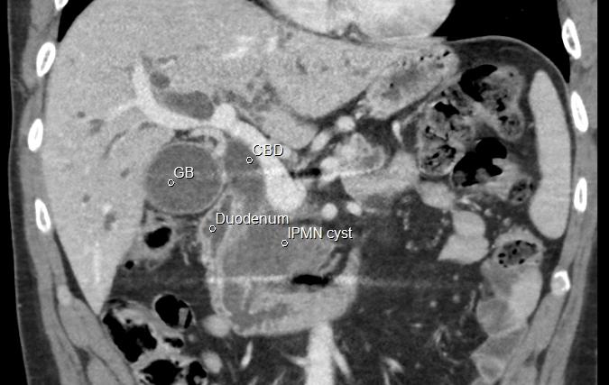 Figure 2: The papilla Vateri in a 46 years old man with IPMN presented with the characteristic fish mouth (figure 2a) appearance. After saline flushing the pig nose (fig 2b) typically seen in patients with pancreatobiliary fistula was revealed.