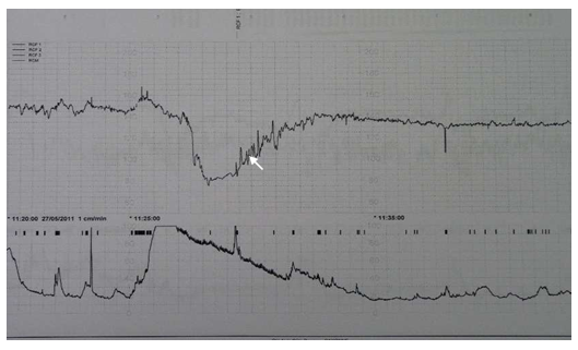 Figure 3: Transient increased variability during the rising phase and the lower level of the heart rate after the deceleration in relation to persistent hypoxemia.