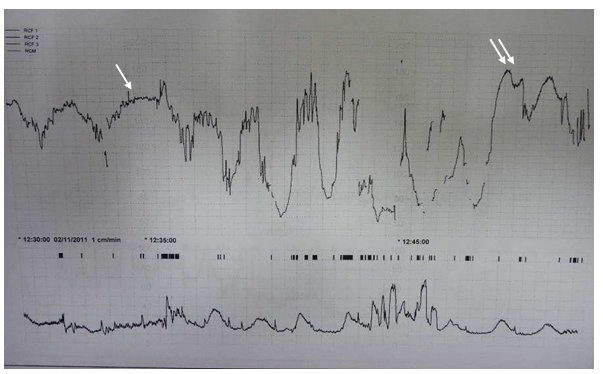 Figure 4: single arrow).