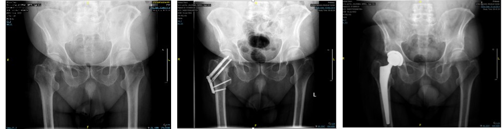 Figure 1: From Left to Right: anterior posterior X ray of a 61 y/o male with left hip Garden 4 fracture(A) who underwent a CRIF with a TFN plate (B) and developed nonunion (C). THA was preformed 8 months after the trauma.