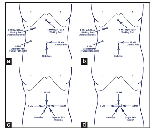 Figure 3: Incision Sites.