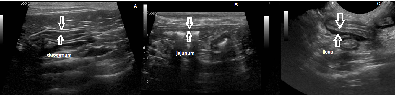 Figure 4: Ultrasound of the small intestine. A. Small intestine with gaseous/mucoid content and preserved peristalsis. Thick walls in duodenum (0,28cm, arrows). B. Normal to thick walls in jejunum (0,21cm - 0,27cm, arrows). C. Thick walls in the ileum (0.36 cm, arrows) with diffuse enhancement of the muscle layer (inflammatory process).