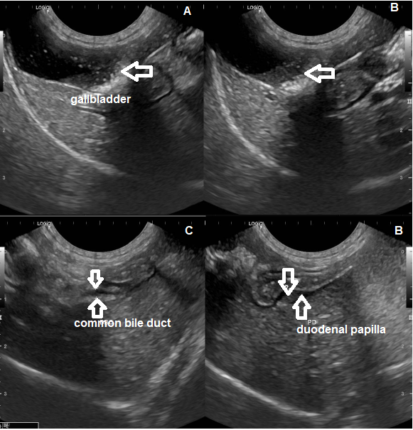Figure 5: Ultrasound of the gallbladder. A. and B. Gallbladder with thin and regular walls, filled with anechogenic content and a discreet amount of biliary sludge with agglomerated mineral sediment/crystals interspersed, reaching up to the cystic duct (0.40 cm of diameter, arrow). C. Common bile duct without signs of dilation (0.21 cm of diameter, arrows). D. Evident duodenal papilla (0.30 cm, arrows), related with inflammatory process.