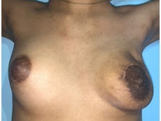 Figure 5: Appearance of the patient at evaluation 6 months after surgery.